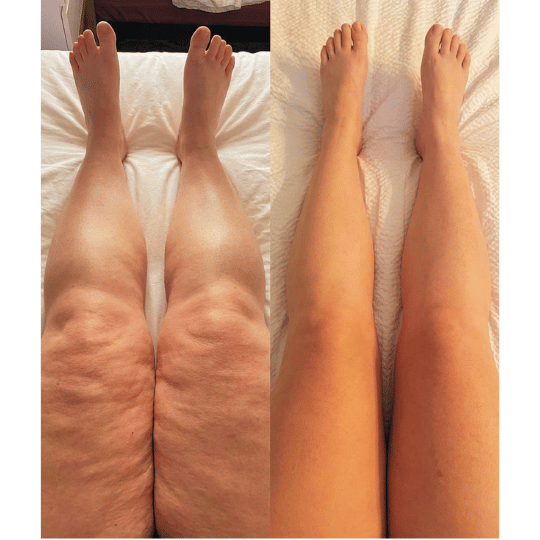 Antes e Depois Prova 1