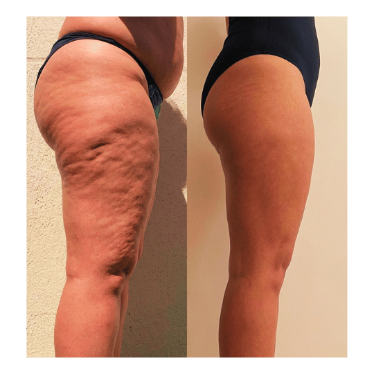 Cardápio Hormonal Anti-Inchaço