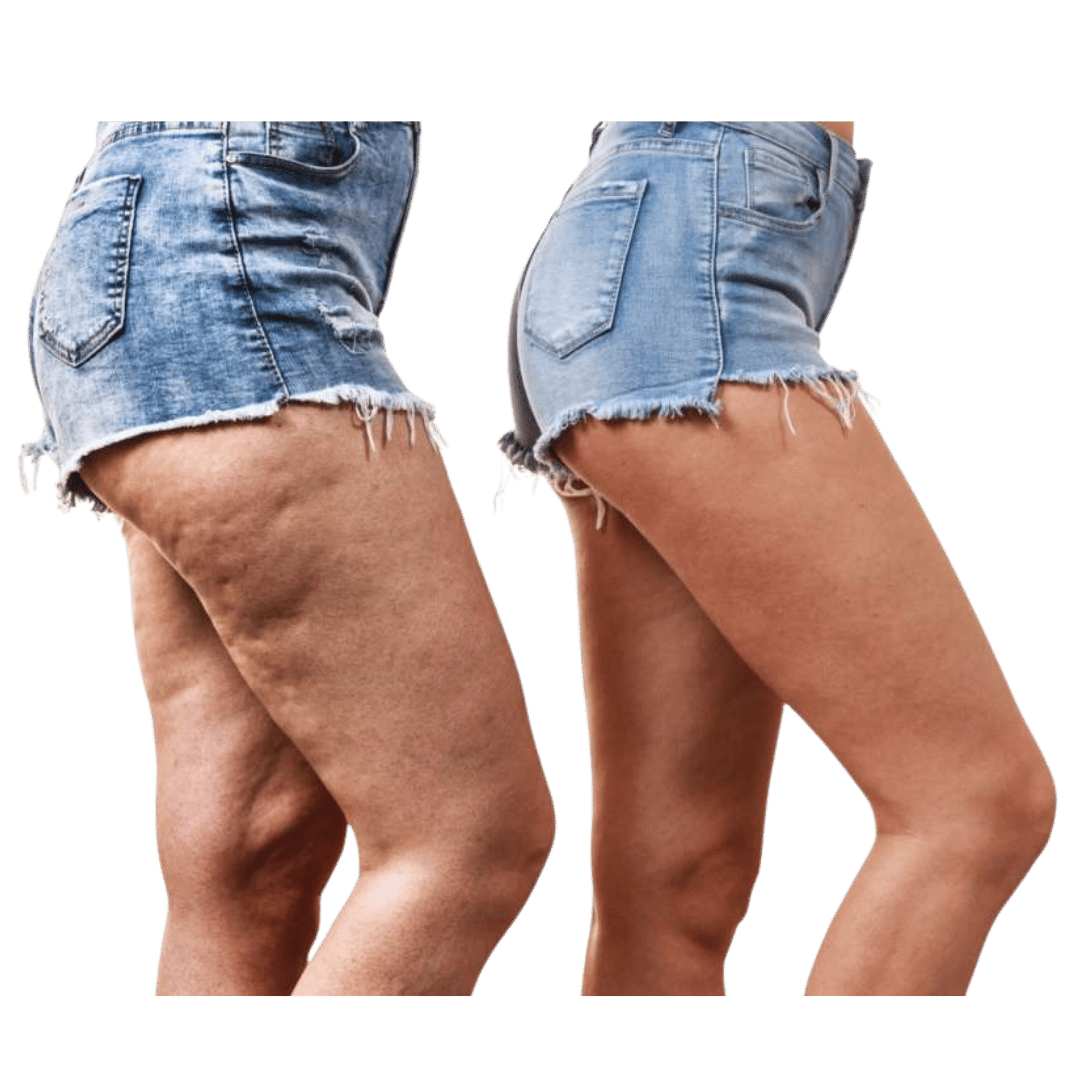 Antes e Depois pernas com lipedema